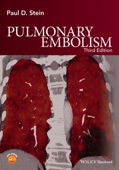 Pulmonary Embolism - Paul Stein D. 